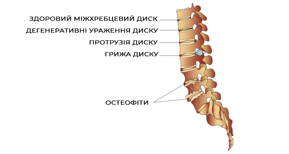 Міфи про біль в спині - розбивання солей