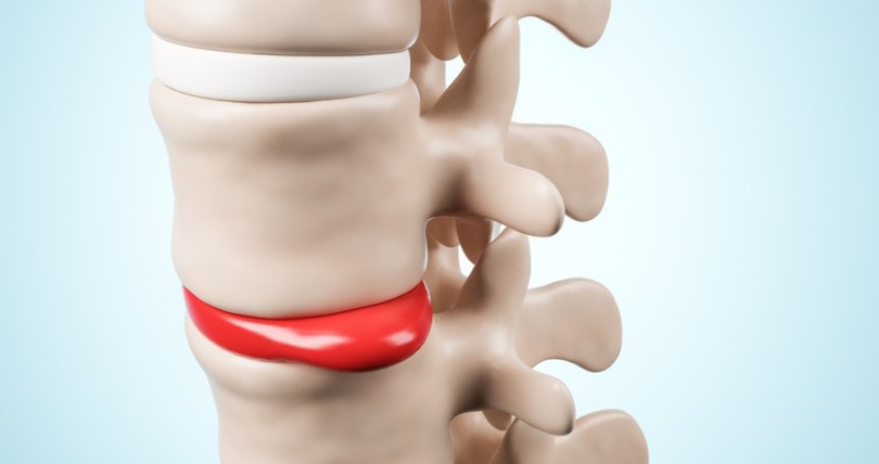 Міфи про біль в спині - протрузія