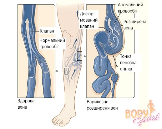 причины варикозного расширения вен