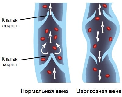 Варикозное расширение вен