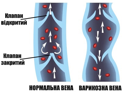 Варикозне розширення вен